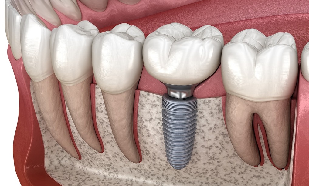 Dental implant model showing titanium post and crown restoration