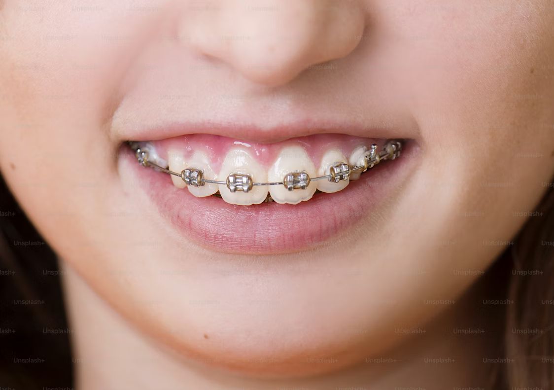 Close-up of orthodontic braces on a patient showing teeth alignment