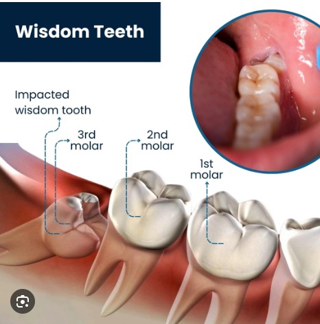 Dentist examining dental X-ray for wisdom teeth assessment