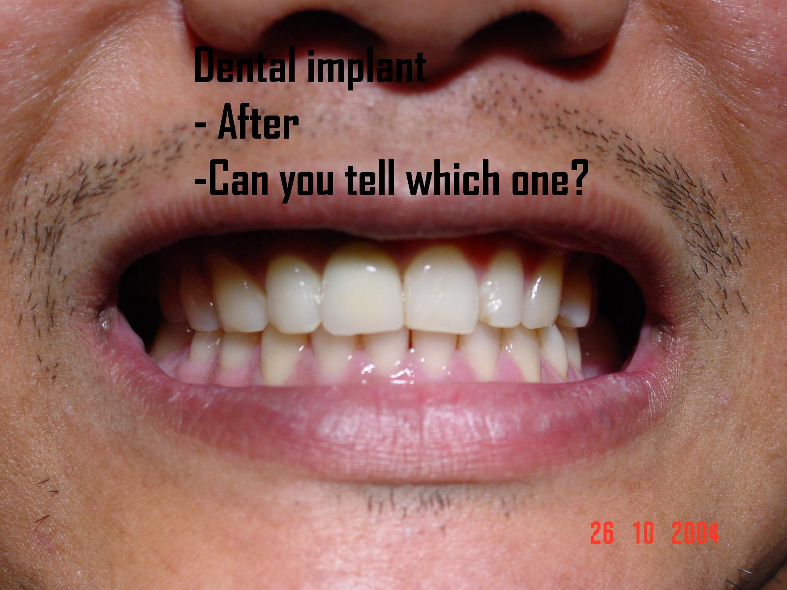 Dental implant — after treatment complete
