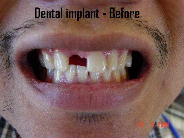Dental implant — before treatment