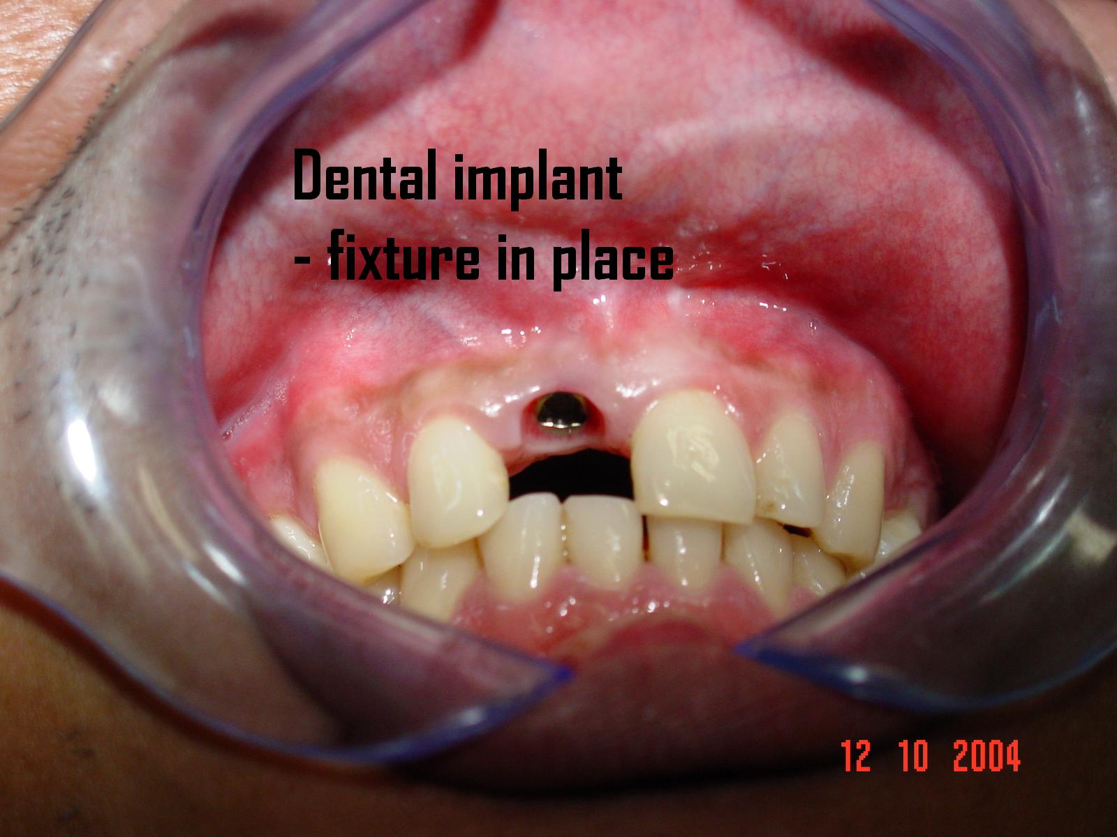 Dental implant — fixture placed in jawbone