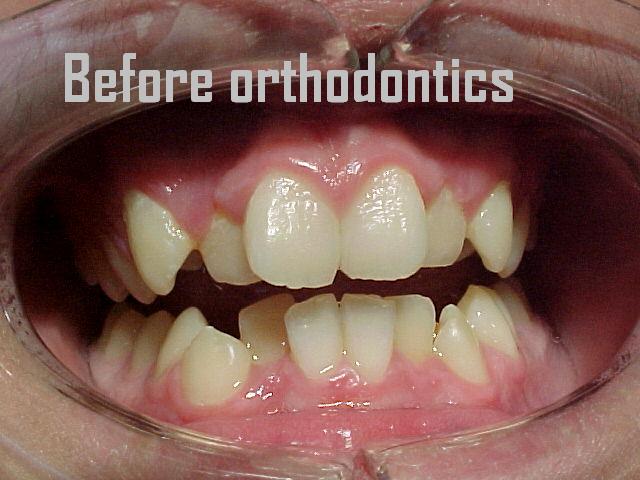 Orthodontics case 1 — before treatment