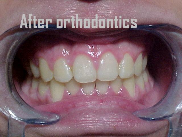 Orthodontics case 1 — after treatment