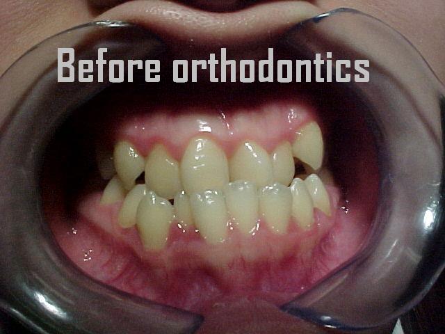 Orthodontics case 2 — before treatment