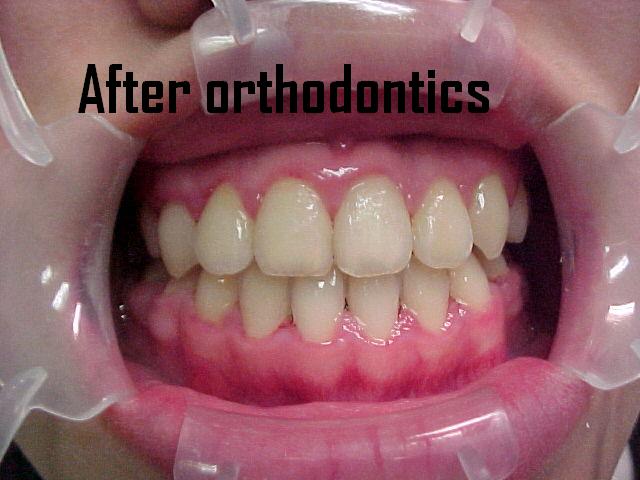 Orthodontics case 2 — after treatment