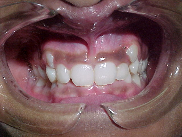 Orthodontics case 3 — before treatment