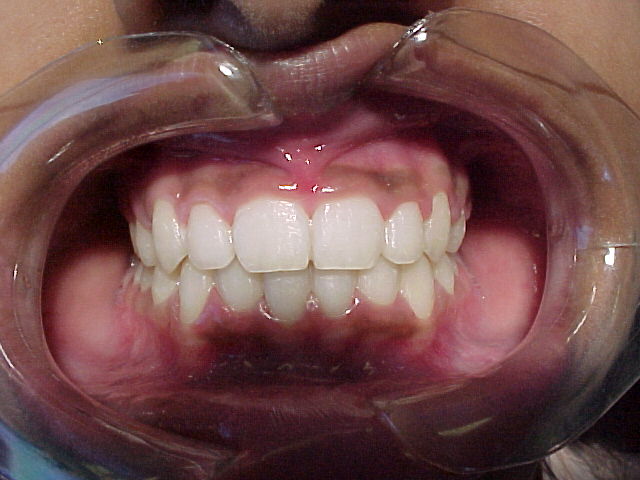 Orthodontics case 3 — after treatment