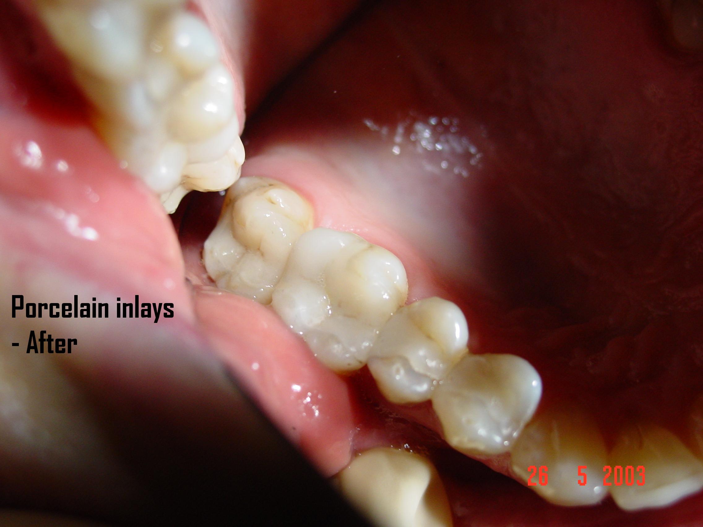 Porcelain inlay — after treatment