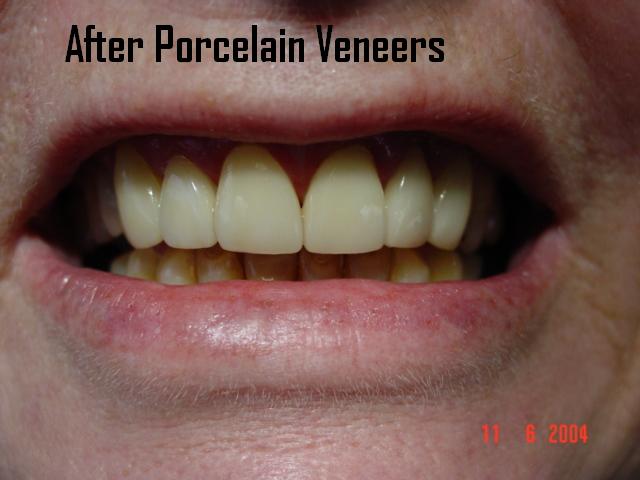 Porcelain veneers case 1 — after treatment