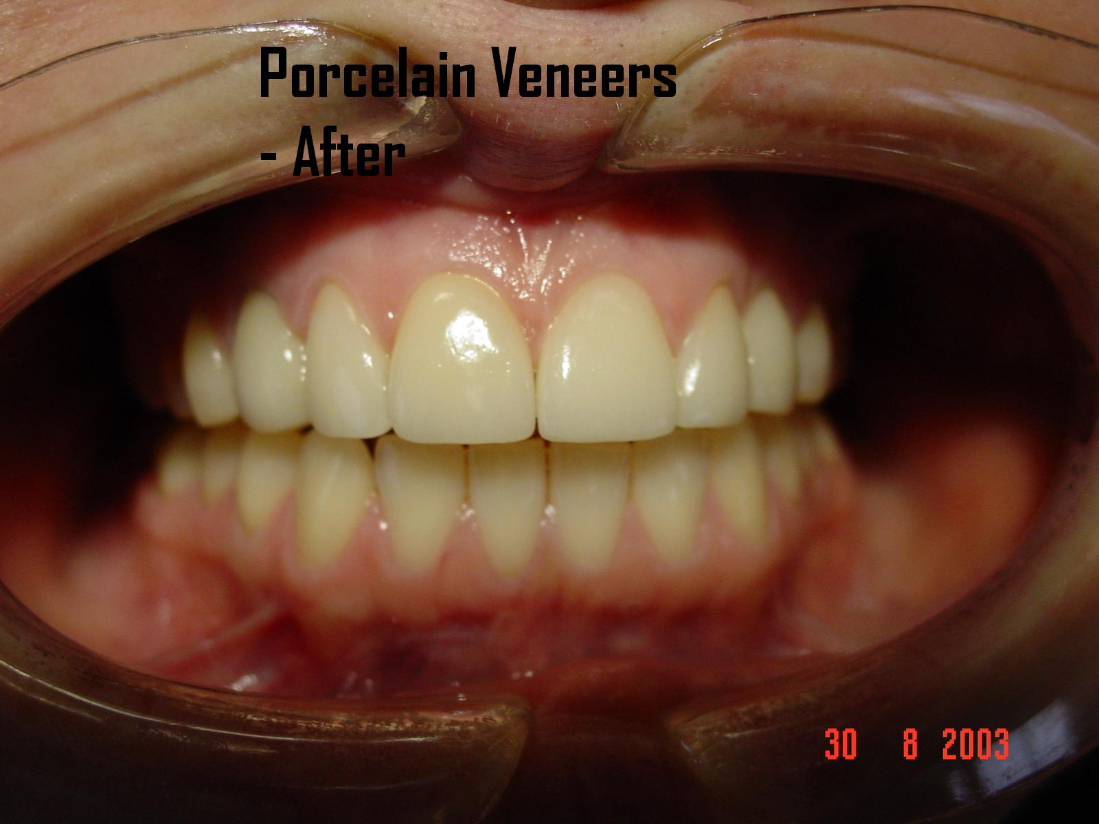 Porcelain veneers case 2 — after treatment