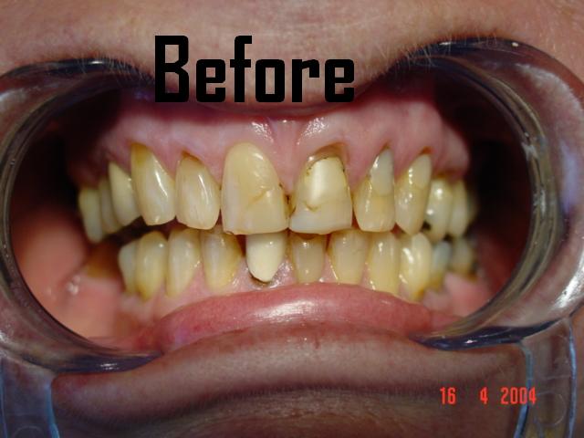 Porcelain veneers case 1 — before treatment