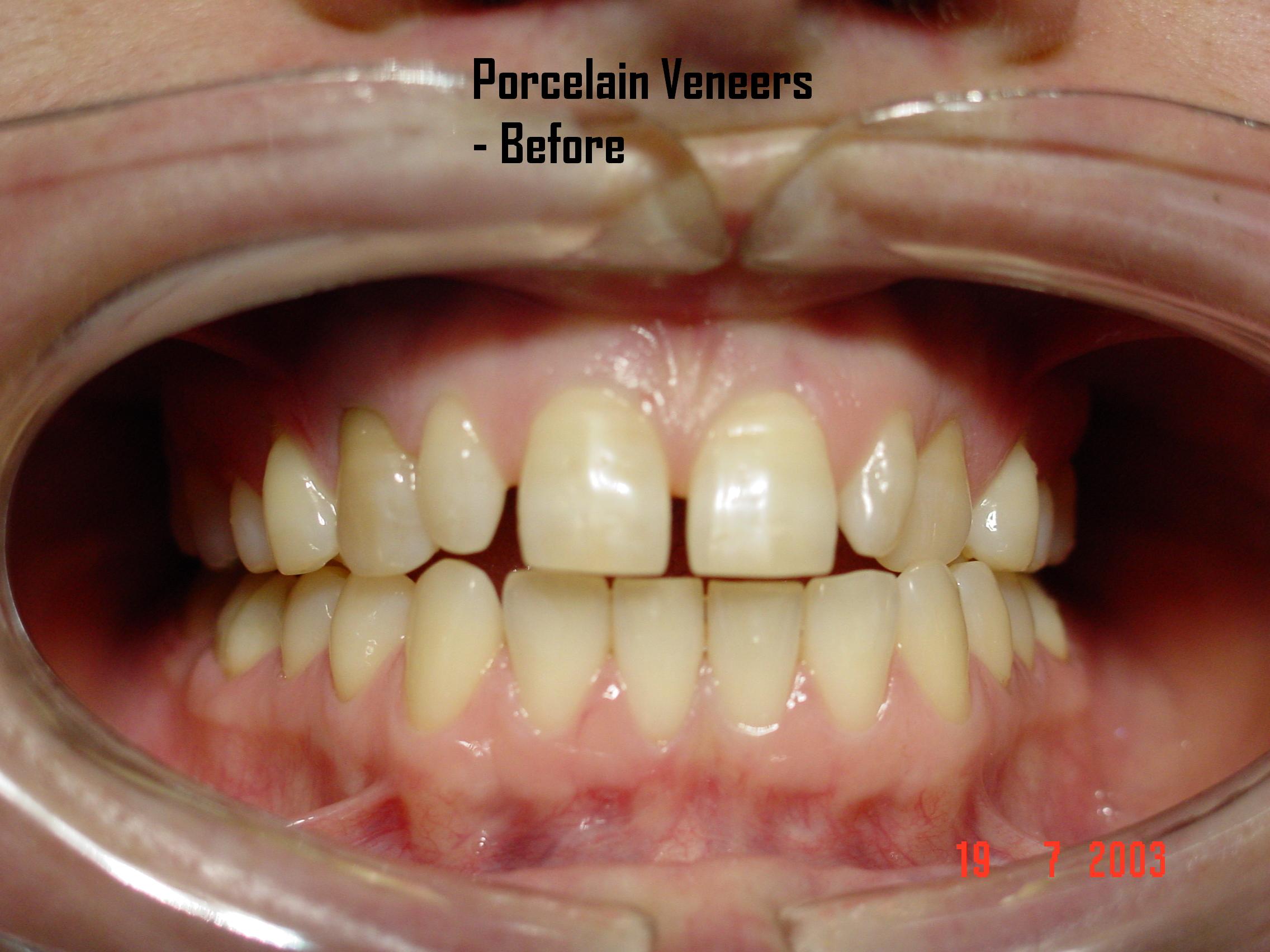 Porcelain veneers case 2 — before treatment